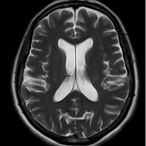 MRI Echo train length (ETL) 25 MRI Echo train length (ETL) 25