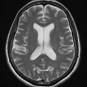 MRI Echo train length (ETL) 5 MRI Echo train length (ETL) 5