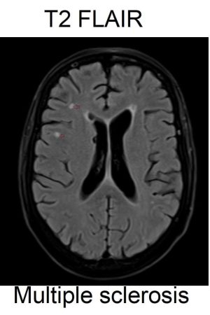 Multiple sclerosis (MS) t2 flair image Multiple sclerosis (MS) t2 flair image