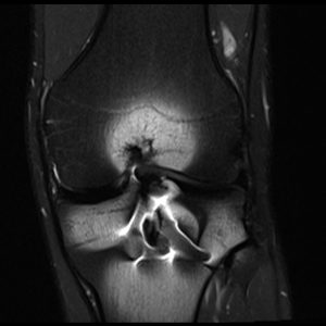 PD FS image of knee with metal implant PD FS image of knee with metal implant