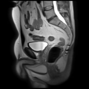 Pelvic image with slice thickness 7mm Pelvic image with slice thickness 7mm