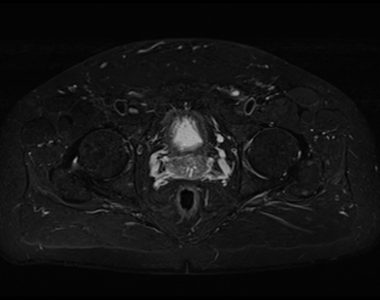 STIR fat saturation image of pelvis 1 STIR fat saturation image of pelvis 1