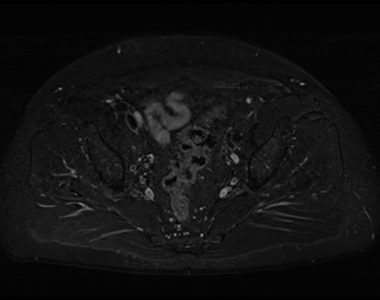 STIR fat saturation image of pelvis STIR fat saturation image of pelvis