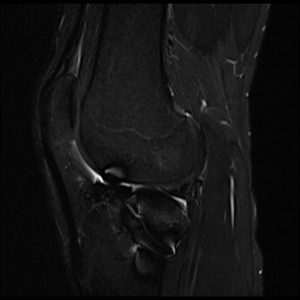 STIR image of knee with metal implant STIR image of knee with metal implant