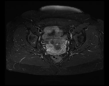 Spectral Adiabatic Inversion Recovery (SPAIR) fat saturation image Spectral Adiabatic Inversion Recovery (SPAIR) fat saturation image
