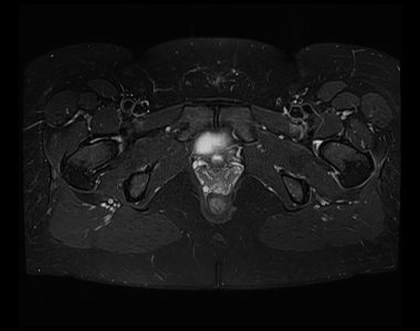 Spectral Adiabatic Inversion Recovery (SPAIR) fat saturation image pelvis Spectral Adiabatic Inversion Recovery (SPAIR) fat saturation image pelvis