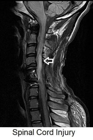 Spinal Cord Injury T2 FLAIR MRI Spinal Cord Injury T2 FLAIR MRI