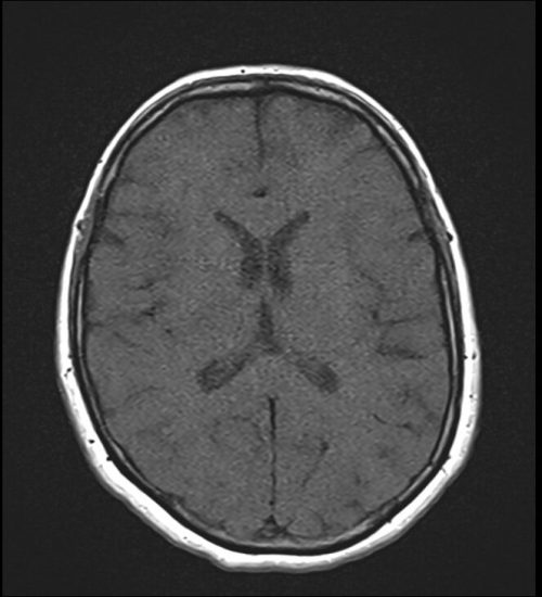 T1 MRI Image with 150 ms TR and 20ms TE T1 MRI Image with 150 ms TR and 20ms TE
