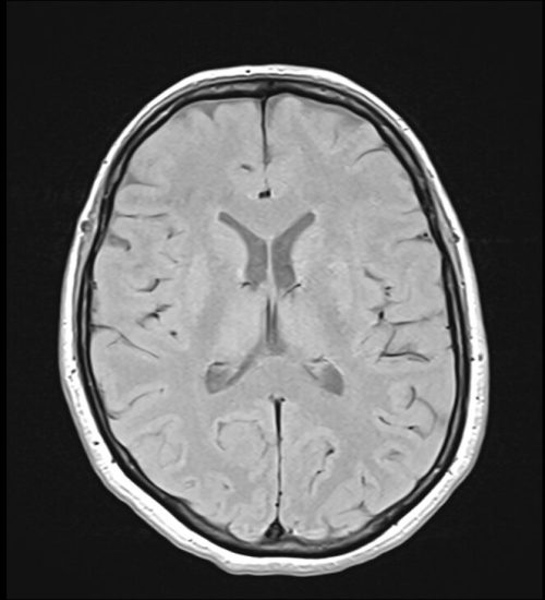 T1 MRI Image with 2000ms TR and 20ms TE T1 MRI Image with 2000ms TR and 20ms TE