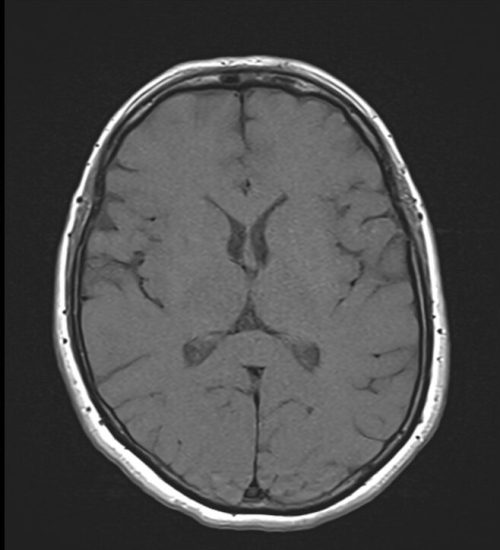 T1 MRI Image with 250ms TR and 20ms TE T1 MRI Image with 250ms TR and 20ms TE