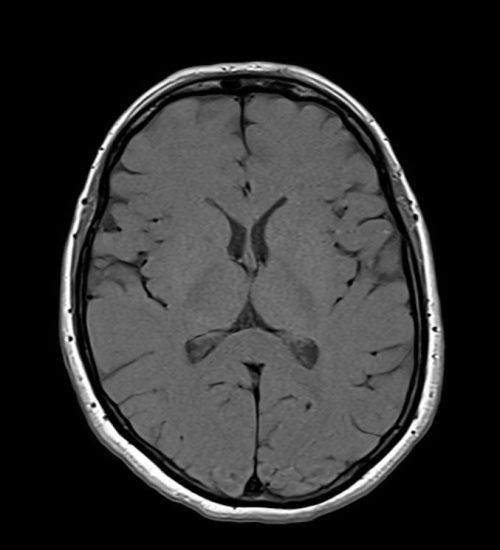 T1 MRI Image with 400ms TR and 20ms TE T1 MRI Image with 400ms TR and 20ms TE
