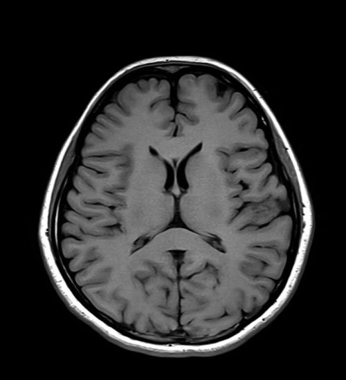 T1 MRI Image with 500ms TR and 17ms TE T1 MRI Image with 500ms TR and 17ms TE