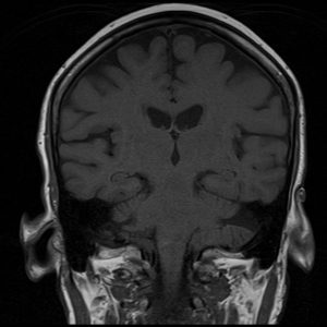 T1 SE image brain T1 SE image brain
