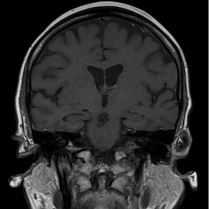 T1 TSE image brain T1 TSE image brain