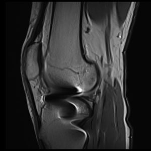 T1 TSE image of knee metal implant T1 TSE image of knee metal implant