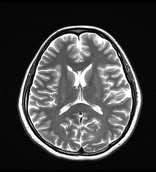 T2 MRI Image with 10000ms TR and 107ms TE T2 MRI Image with 10000ms TR and 107ms TE