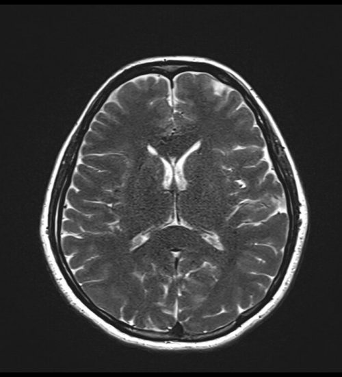 T2 MRI Image with 1000ms TR and 107ms TE T2 MRI Image with 1000ms TR and 107ms TE
