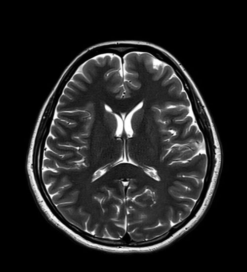 T2 MRI Image with 2500ms TR and 20ms TE T2 MRI Image with 2500ms TR and 20ms TE