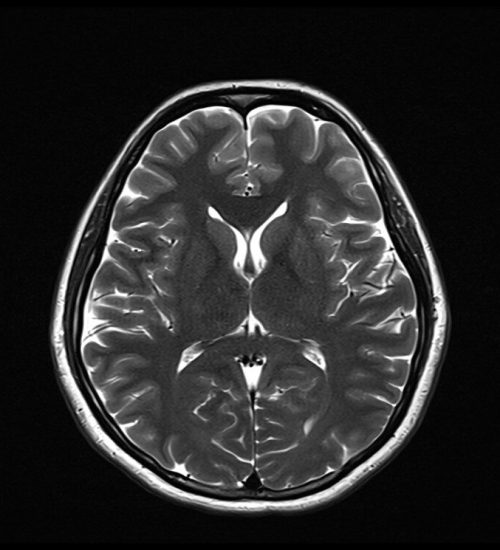 T2 MRI Image with 4000ms TR and 107ms TE T2 MRI Image with 4000ms TR and 107ms TE