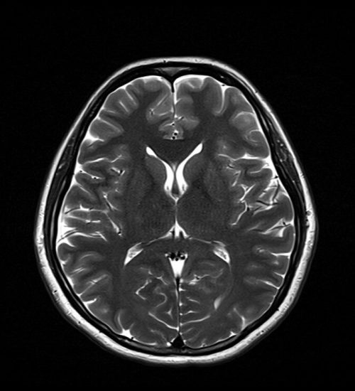 T2 MRI Image with 5000ms TR and 100ms TE T2 MRI Image with 5000ms TR and 100ms TE
