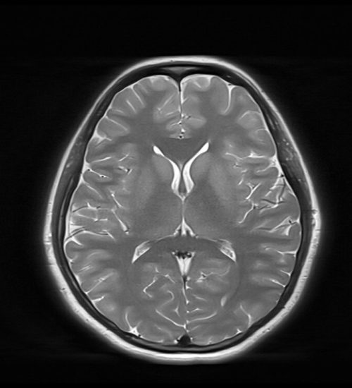 T2 MRI Image with 5000ms TR and 20 ms TE T2 MRI Image with 5000ms TR and 20 ms TE