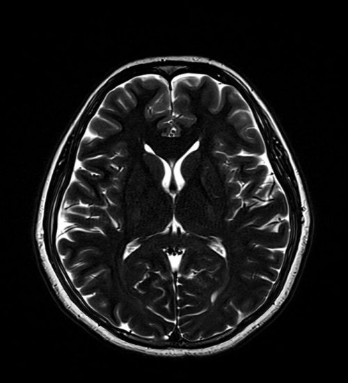 T2 MRI Image with 5000ms TR and 250ms TE T2 MRI Image with 5000ms TR and 250ms TE