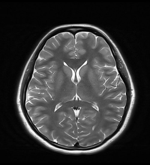 T2 MRI Image with 5000ms TR and 50ms TE T2 MRI Image with 5000ms TR and 50ms TE