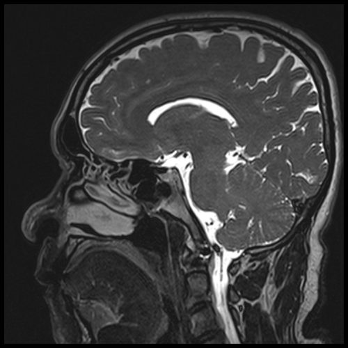 T2 SPACE 3D Mid-brain Sagittal 0.5 mm 2 T2 SPACE 3D Mid-brain Sagittal 0.5 mm 2