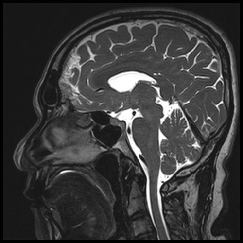 T2 SPACE 3D Mid-brain Sagittal 0.5 mm 3 T2 SPACE 3D Mid-brain Sagittal 0.5 mm 3