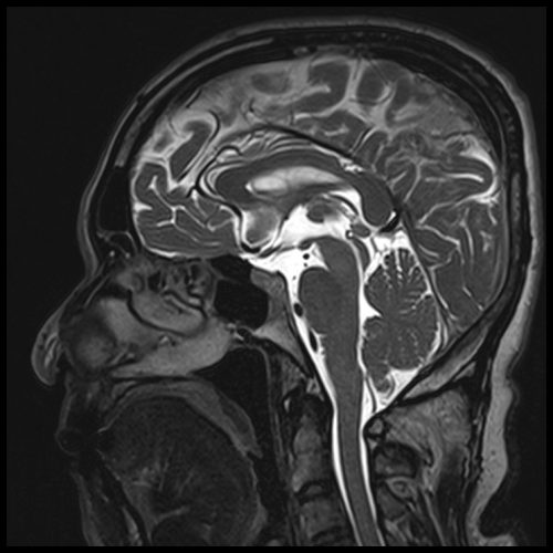 T2 SPACE 3D Mid-brain Sagittal 0.5 mm 4 T2 SPACE 3D Mid-brain Sagittal 0.5 mm 4