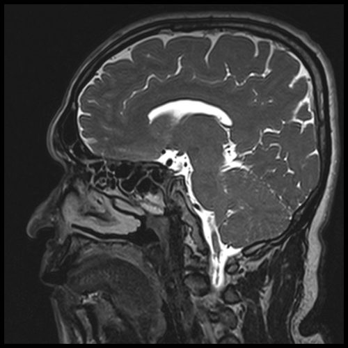 T2 SPACE 3D Mid-brain Sagittal 0.5 mm 6 T2 SPACE 3D Mid-brain Sagittal 0.5 mm 6