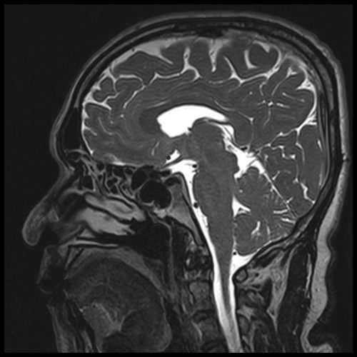 T2 SPACE 3D Mid-brain Sagittal 0.5 mm5 T2 SPACE 3D Mid-brain Sagittal 0.5 mm5