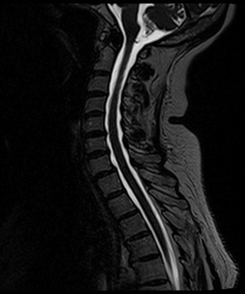 T2 SPACE sagittal 0.7 mm isotropic with high TE CSF leack protocol image 2 T2 SPACE sagittal 0.7 mm isotropic with high TE CSF leack protocol image 2