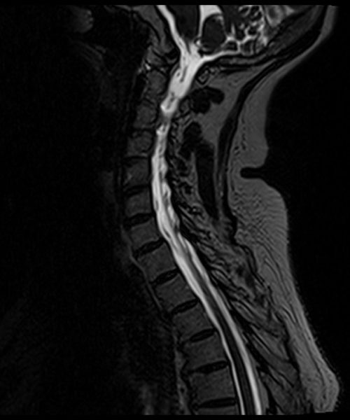 T2 SPACE sagittal 0.7 mm isotropic with high TE CSF leack protocol image T2 SPACE sagittal 0.7 mm isotropic with high TE CSF leack protocol image