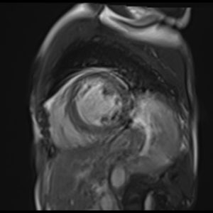 T2 TRUEFISP CINE performed on an uncooperative patient. T2 TRUEFISP CINE performed on an uncooperative patient.