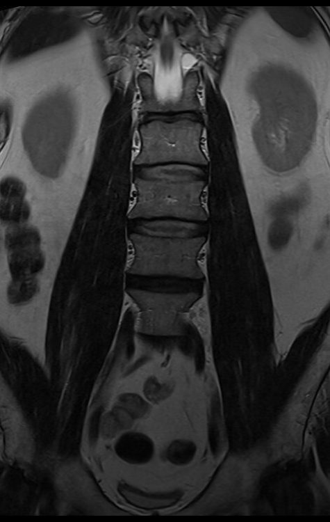 T2-weighted turbo spin-echo coronal image of psoas T2-weighted turbo spin-echo coronal image of psoas