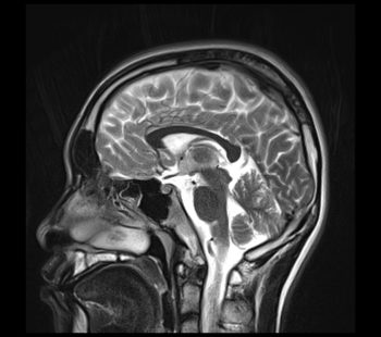 blade artifact with 12% oversample blade artifact with 12% oversample