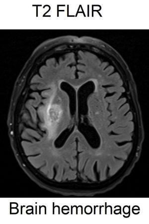 brain hemorrhage t2 flair image brain hemorrhage t2 flair image