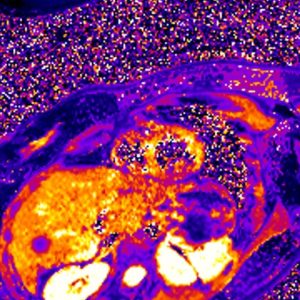 cardiac MRI T2 star mapping cardiac MRI T2 star mapping