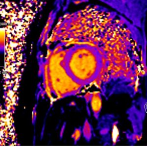cardiac MRI native T1 mapping cardiac MRI native T1 mapping