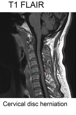 disc bulge T1 FLAIR image herniated disks shown in T1 FLAIR image