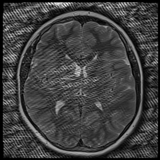 herringbone artifact mri herringbone artifact mri