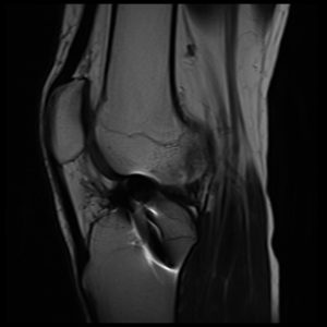 knee metal implant Metal Artifact Reduction Sequence (MARS) image knee metal implant Metal Artifact Reduction Sequence (MARS) image