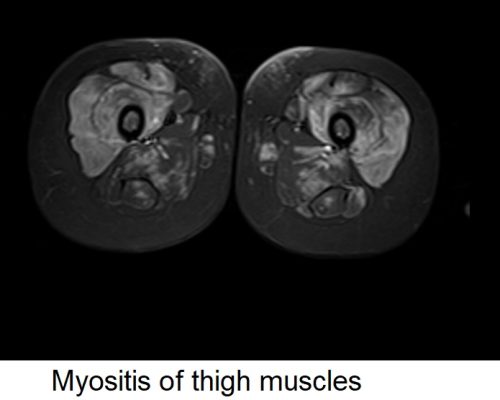 myositis of thigh muscles myositis of thigh muscles