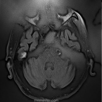 rf overflow artifact mri rf overflow artifact mri