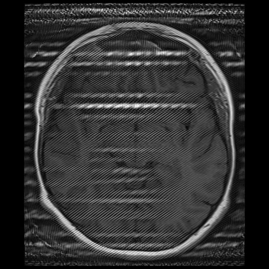rf spike artifact rf spike artifact mri
