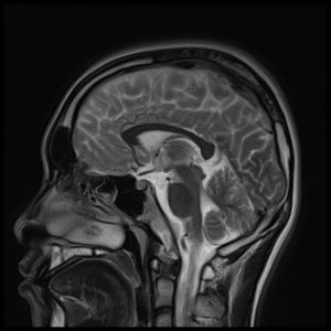 sagittal blade imaging of brain sagittal blade imaging of brain