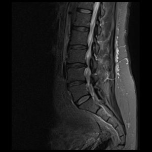 sagittal blade imaging ofspine sagittal blade imaging ofspine