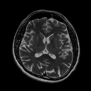 slice 3mm nex 2 Slice thickness 3mm and NEX 2 MRI image