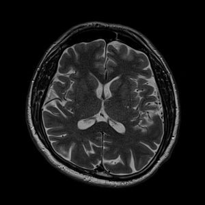 slice 5 nex 1 slice thickness 5mm and NEX 1 MRI image